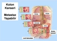 Kolon Kanseri Metastaz