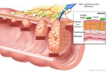 Kolon Ca Belirtileri ve Tedavisi
