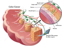 Kolon Kanseri İlaçları Kullanımı ve Faydaları Nelerdir?