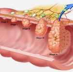 Kolon Kanseri Kemoterapi Belirtileri ve Tedavisi