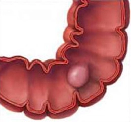 Kolon Kanseri Yaşam Süresi?