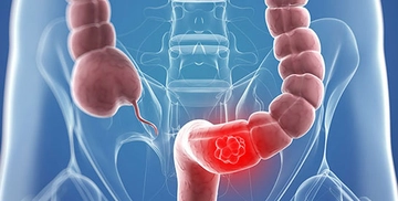 Kolon Türleri ve Özellikleri